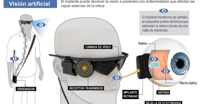 Los tres primeros implantados con un ojo biónico muestran importantes avances en su visión