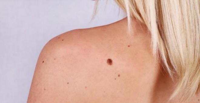 El melanoma es el cáncer de piel menos común pero el que mayor tasa de mortalidad tiene.