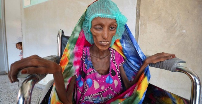 Saida Ahmad Baghili, de 18 años, sufre una desnutrición aguda y grave y se encuentra hospitalizada en Al Hudayda. / Europa Press