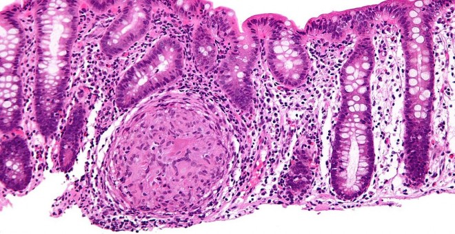 Biopsia endoscópica donde se puede apreciar inflamación granulomatosa del colon en un caso de enfermedad de Crohn. WIKIPEDIA