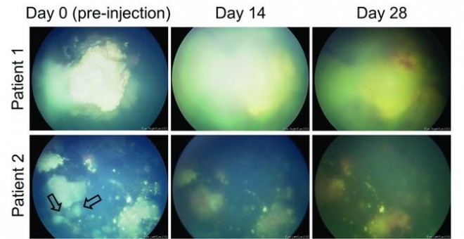 Evolución de los ojos de dos pacientes que recibieron la terapia / G. Pascual-Pasto et al., Science Translational Medicine