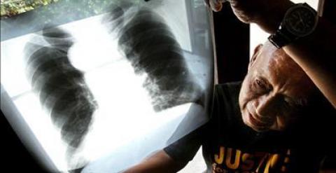 En la imagen, un hombre enfermo de cancer enseña la radiografía de sus pulmones. EFE