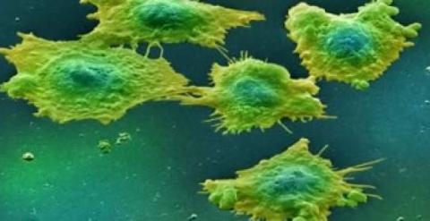 Células afectadas por cáncer de colon