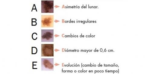 Regla del ABCDE del cáncer de piel. /IDEI