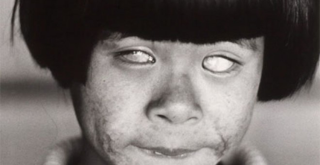 La "niña que vio la luz que brilla como mil soles" en Hiroshima, con la cara y los ojos quemados.