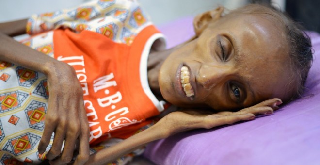 Saida Ahmad Baghili, de 18 años, sufre una desnutrición aguda y grave y se encuentra hospitalizada en Al Hudayda. / Europa Press