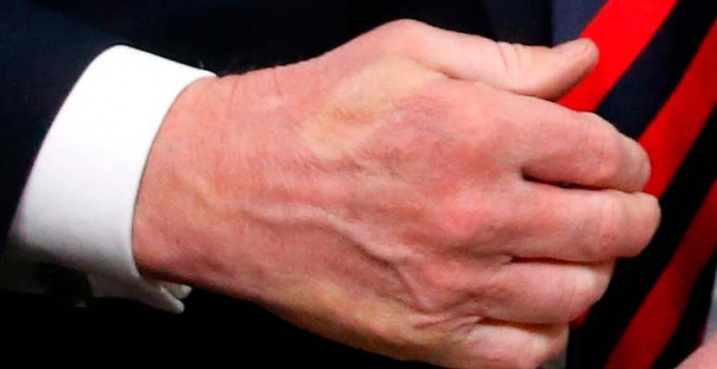 La mano de Trump marcada con los dedos de Trump. (LEAH MILLS | REUTERS)