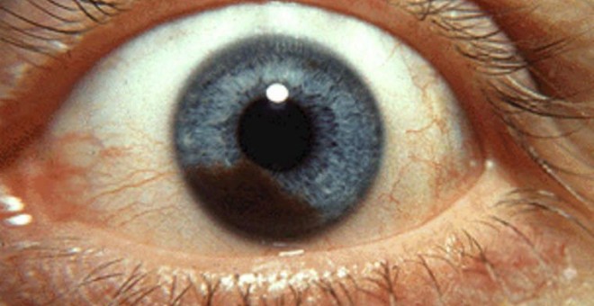 El melanoma ocular, el gran desconocido y el más infradiagnosticado