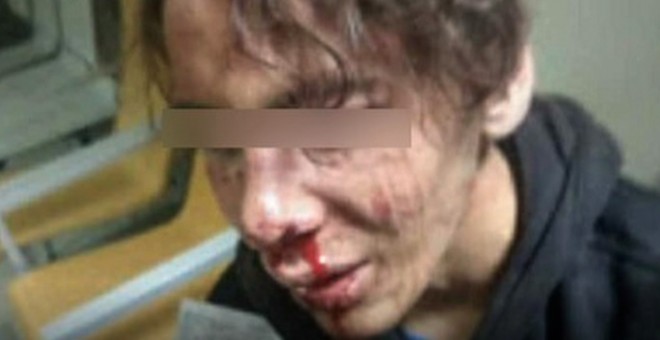 Las heridas del menor tras la agresión de varios policías en Melilla.- ATLAS