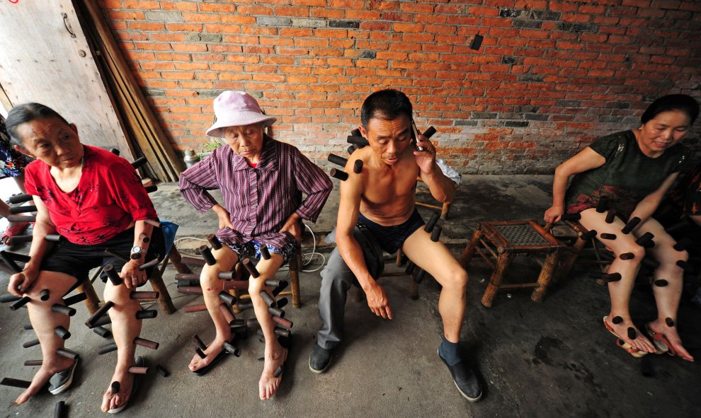 La gente recibe un tradicional tratamiento de 'cupping' en una clínica en Pujiang, China. REUTERS