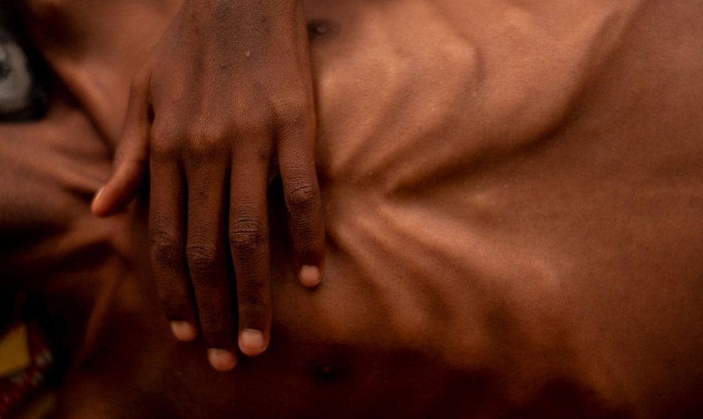 Golfi Bemonza de Bossongo, que sufre de SIDA y desnutrición aguda severa, aparece en la Clínica Pediátrica apoyada por UNICEF, en Bangui