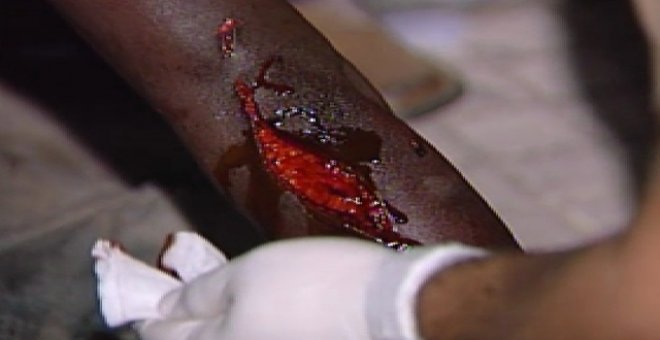 Una herida causa por las cuchillas de la valla de Melilla en 2013.- ATLAS
