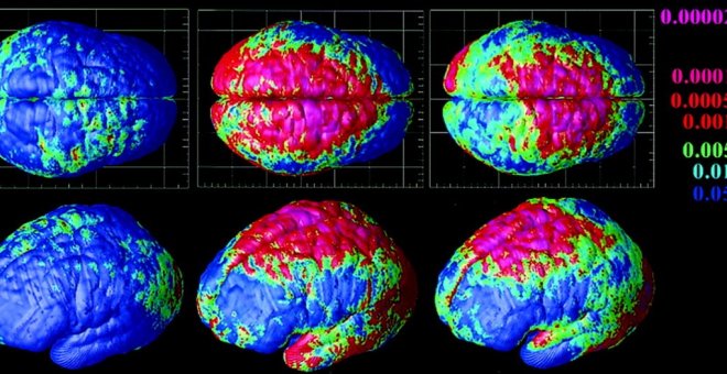 Depresión, esquizofrenia, autismo y trastorno bipolar son más similares de lo que sus síntomas indican