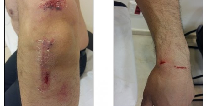 Heridas provocadas a un camarero tras una agresión homófoba y racista en Madrid./Público
