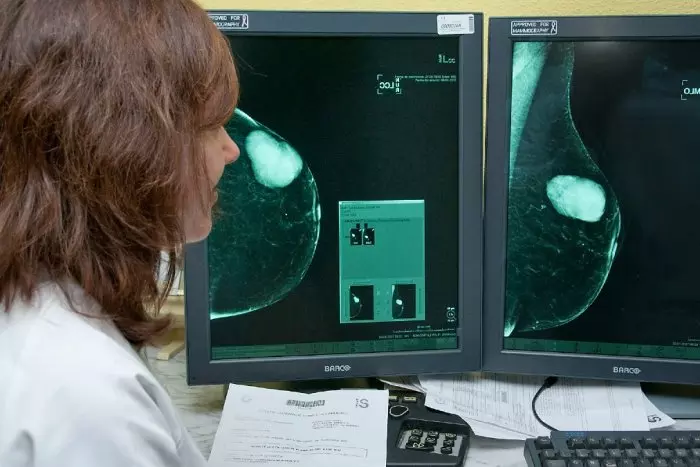 Tres de cada quatre pacients amb càncer de mama metastàtic podrien rebre una teràpia dirigida