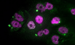 Células tumorales de adenocarcinoma de páncreas que muestran signos de daño en el ADN del núcleo (puntos blancos) y de micronúcleos (en verde), después de un tratamiento con taxol seguido de inhibidores de CDK4/6. /CNIO