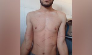 Las cicatrices de Abderrahim, el solicitante de asilo deportado el pasado marzo a Argelia. Según relata, son fruto de torturas sufridas en su país durante su secuestro por un grupo criminal.