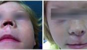 Reconstruyen la nariz de una niña a partir del cartílago y piel de su propia oreja