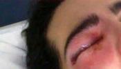 Iñaki, herido en el ojo por un pelotazo el 22-M: "Cuando aprietan el gatillo pueden destrozar una vida"