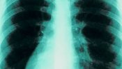 Una vacuna mejora la supervivencia del cáncer de pulmón