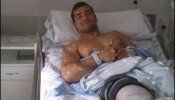La sanidad valenciana retira una prótesis de 152 euros a un joven que no podía pagarla