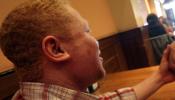 Un negro albino pide protección como refugiado