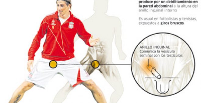 Una hernia fantasma amenaza a Torres