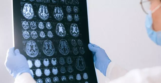 Investigadors de la URV identifiquen un grup de molècules que poden millorar el diagnòstic precoç de l'alzheimer