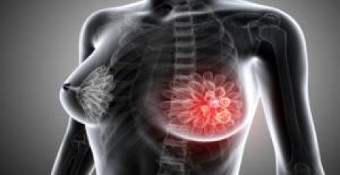 Investigan nueva dianas terapéuticas para tratar el cáncer de mama