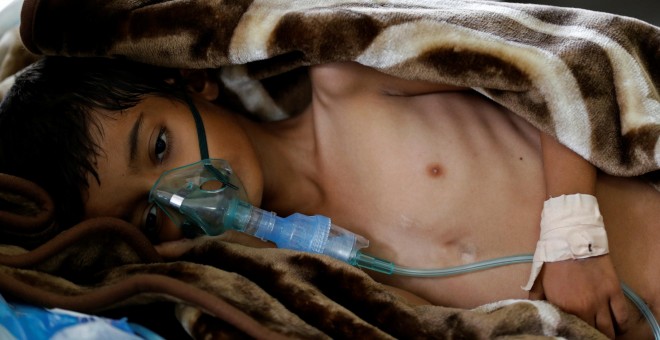 Un niño de ocho años con síntomas de desnutrición en un hospital de Saná. - REUTERS