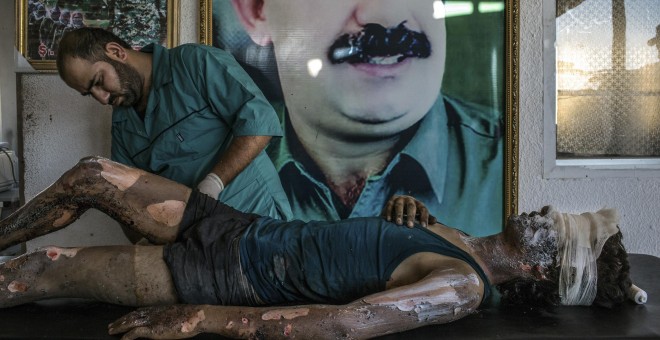 Un médico aplica una pomada sobre las quemaduras de Jacob, un combatiente de 16 años del grupo que se autodenomina Estado Islámico (EI), en un hospital de AlHasaka, situado en una región al noreste de Siria controlada por los kurdos. - MAURICIO LIMA / Pri