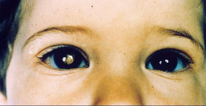 Niño con retinoblastoma/Agencia Sinc