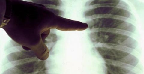 Radiografía de tórax. EFE (Archivo)