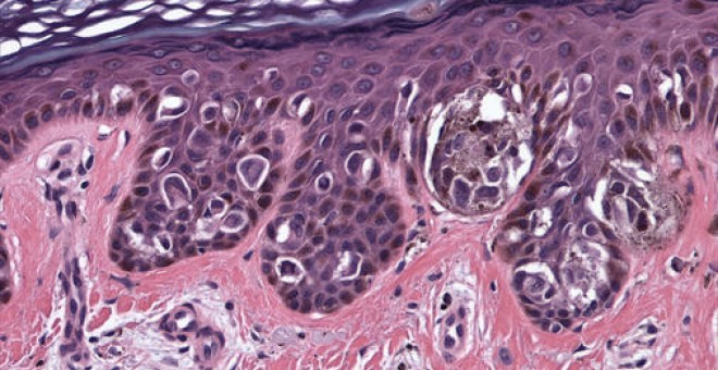 El melanoma es, junto al cáncer de colon, una enfermedad que se podría combatir empleando esta nueva célula / Edgepath