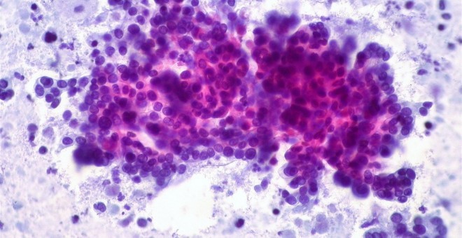 Imagen de un cáncer de páncreas. Flickr Ed Uthman