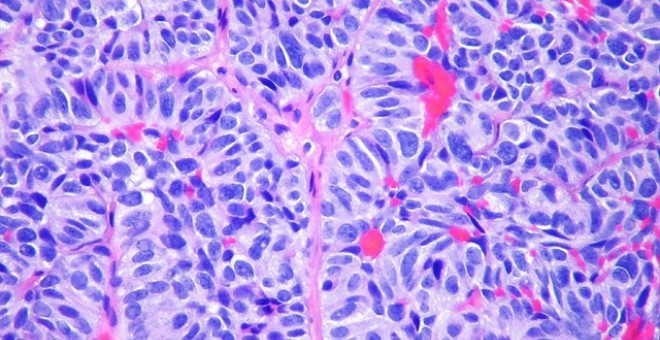 Imagen de archivo de una metástasis en el pulmón. FLICKR/PULMONARY PATHOLOGY