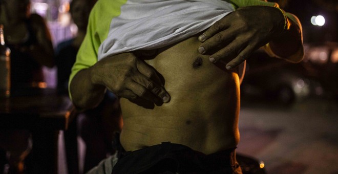 Tirso Bolívar muestra la cicatriz de una herida de bala en la parroquia 23 de Enero de Caracas, Venezuela.- JARO VARGAS