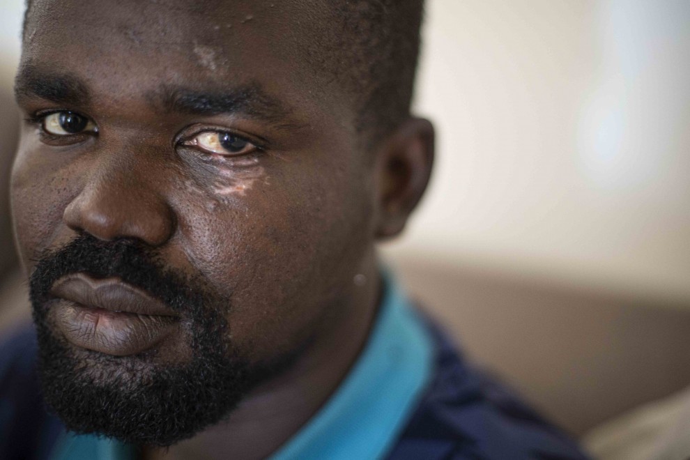 Nurdin Sanusi, refugiados sudanés devuelto en caliente cundo cruzó la valla de Melilla el pasado 24 de junio, muestra sus heridas en un lugar seguro en Casablanca, Marruecos.