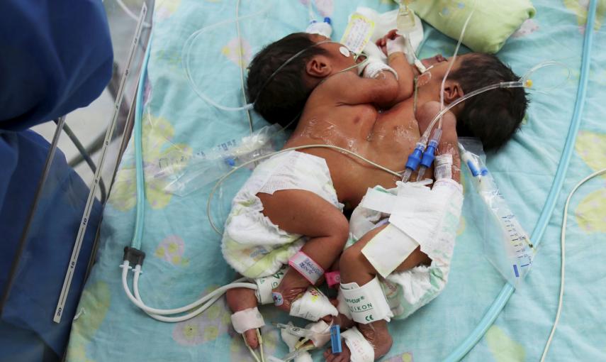 Unos gemelos siameses de tres días, en el hospital del Instituto Nacional del Niño, en Lima (Perú). Los médicos tratarán de separar sus cuerpos mediante una intervención quirúrgica.- JORGE BARTRA (REUTERS)