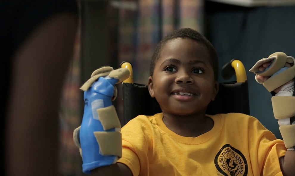 Zion Harvey, un niño de ocho años, tras recibir un trasplante de las dos manos a principios de este mes en Filadelfia, Estados Unidos. Harvey perdió sus manos y sus pies por una infección cuando tenía dos años. La operación duró 11 horas y participaron 40