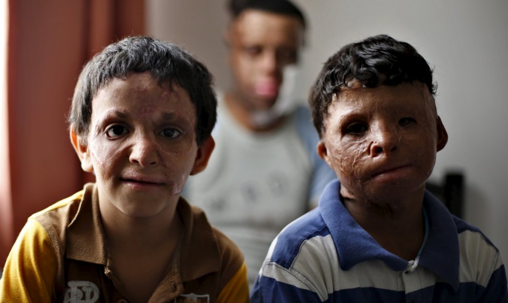 Hamza Mohammed (I), un yemení de 6 años, Saleim Ahmed (D), de 12 años y Waa'el Sameer (C), de 23 años, que resultaron heridos hace unos cuatro años durante la violencia en su país, esperan a ser operados por cirujanos plásticos en un nuevo hospital dirigi