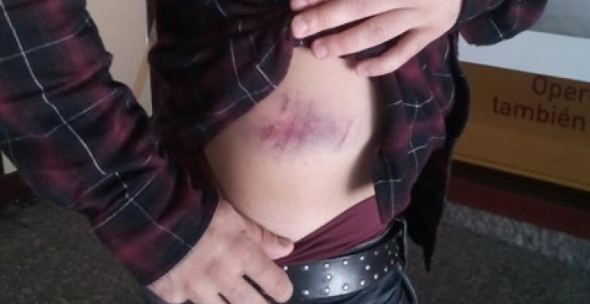 Uno de los heridos muestra el hematoma provocado tras recibir el impacto de una silla lanzada por un miembro la Liga Joven.