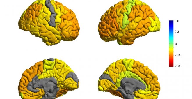 Representación de cerebros con trastorno bipolar