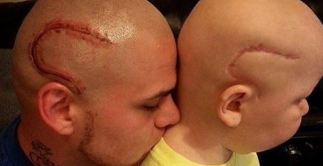 Josh Marshall (izquierda) y su hijo Gabriel Marshall (derecha) con la misma cicatriz.
