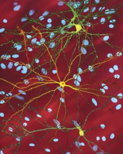 Tejido neuronal de paciente de enfermedad de Huntington. La neurona amarilla muestra una acumulación de proteína anormal./ S.FINKBEINER