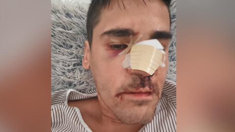 Fonsi Loaiza tras la agresión, este viernes. Fonsi Loaiza tras la agresión, este viernes.