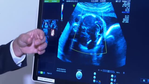 La Fundación La Caixa impulsa el primer gran proyecto europeo de placenta artificial La Fundación La Caixa impulsa el primer gran proyecto europeo de placenta artificial