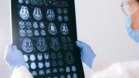 Investigadors del Clínic descobreixen perquè els símptomes de l'Alzheimer són més greus en els pacients més joves Investigadors del Clínic descobreixen perquè els símptomes de l'Alzheimer són més greus en els pacients més joves