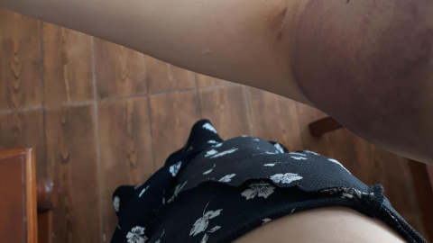 Imagen de las lesiones sufridas por la mujer transexual. ATA Imagen de las lesiones sufridas por la mujer transexual. ATA