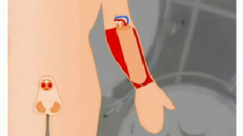 Reconstruir un pene Reconstruir un pene